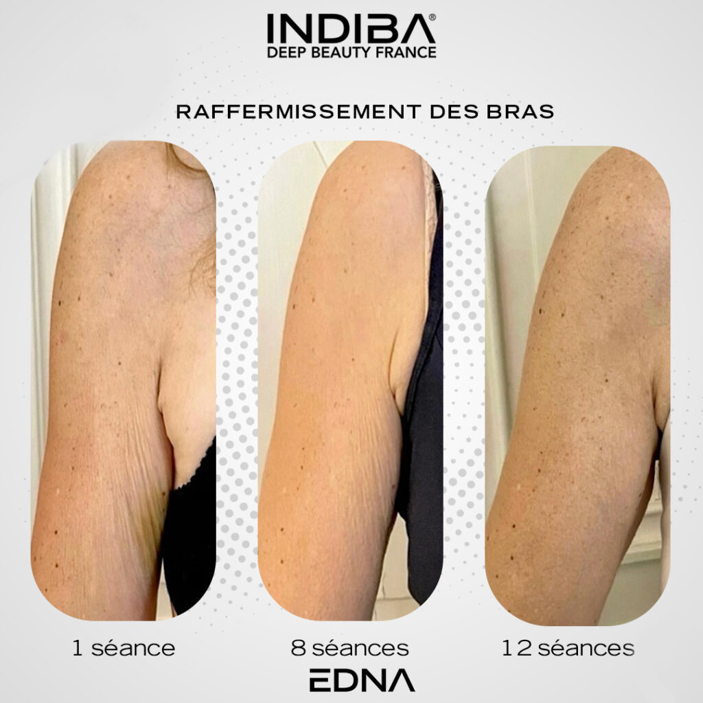 Bras-1.jpg