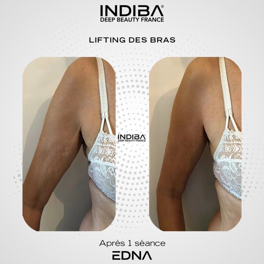 Bras-2.jpg