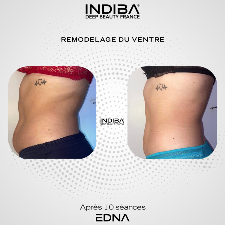 Remodelage-du-ventre-2.jpg